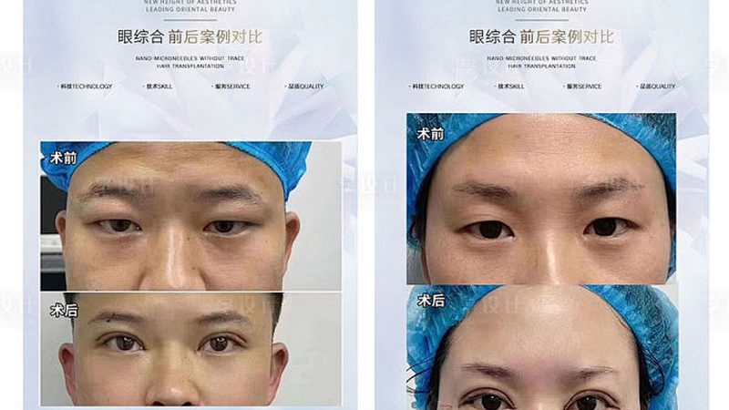 北京埋线提升步骤揭秘：美丽无痕，青春再现