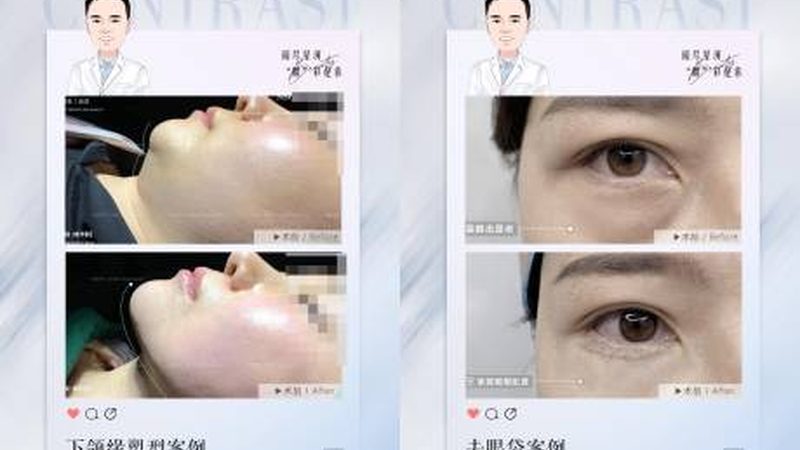 光子嫩肤：揭秘操作流程与价格构成