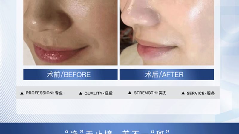 热玛吉五代VS四代：揭秘差异，选对划算