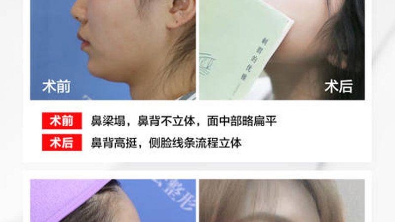 光子嫩肤祛痘印，真实用户分享她的蜕变之旅